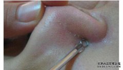 你能收紧鼻子痤疮吗？
