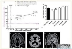 人际障碍包括心理障碍，语义障碍，感觉障碍和
