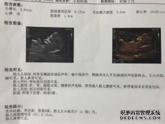 十二周胎儿NT的正常值是多少？